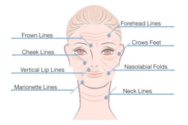 Wrinkles: Causes & Natural Care